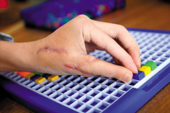 小伙大拇指粉碎被切除 医生将脚趾移植自如玩手机