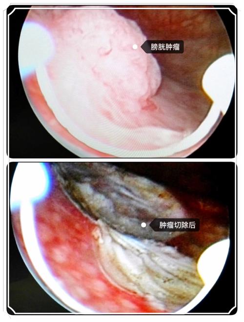 膀胱肿瘤切除前后对比图.
