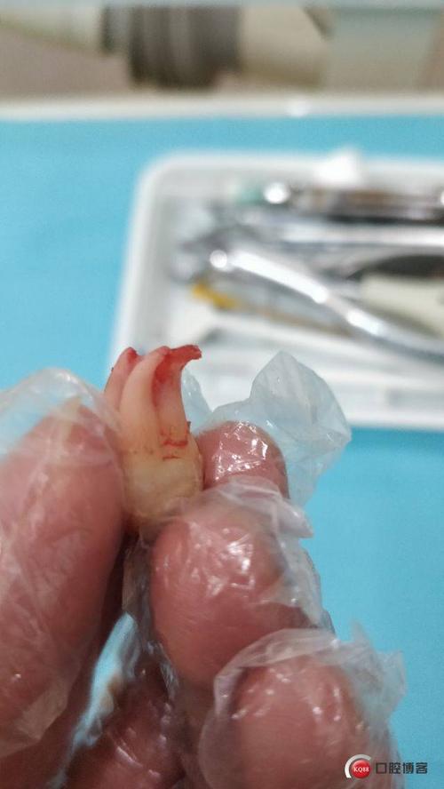 一例上8简单且"危险"的上颌智齿拔除