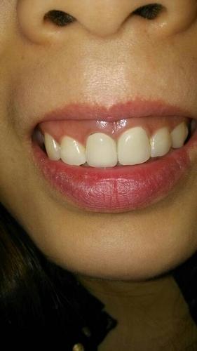 戴临时牙模时刺激了牙龈,导致牙龈有点点萎缩,看上去有点点缝隙,做了