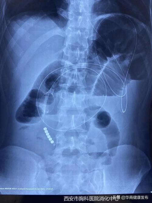 得了肠梗阻怕手术一根管子就搞定