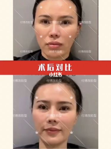 正颌手术-付国友改脸型_正颌手术_脸型_美妆_医美整形