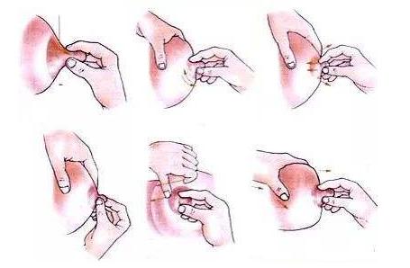 乳头凹陷矫正常使用的方法有保守治疗法,保留乳腺导管治疗法及乳腺