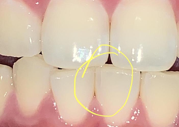 牙隐裂晚期是怎样的?