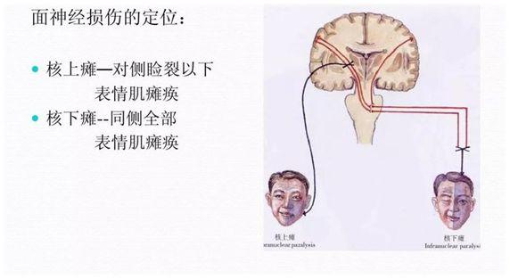 面瘫,在医学上称为面神经麻痹,是指各种因素作用下,面神经受到损伤后