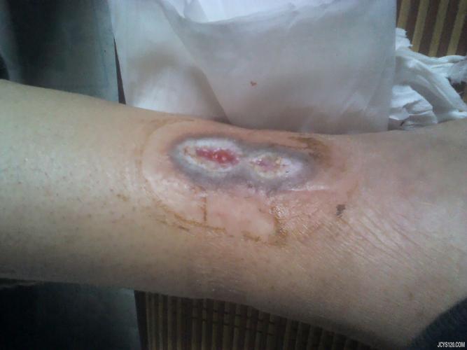 治疗一例糖尿病并发症——右小腿内侧肌肉坏死