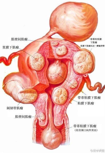 45,子宫肌瘤