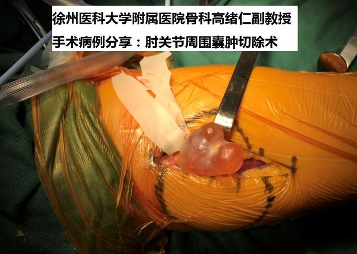 徐州二院骨科专家高绪仁手术病例分享:肘关节周围囊肿