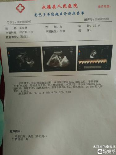 孕33周时候照的胎宝宝双顶径8.6股骨长