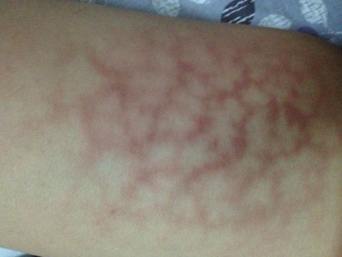 大腿内侧发紫是什么原因?如何消退?