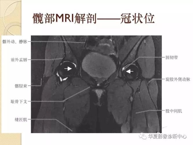 髋关节解剖及疾病的mri诊断