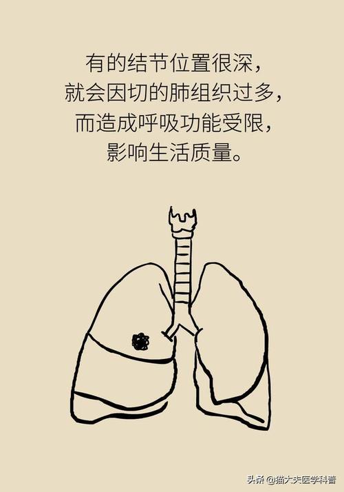 王俊院士:90%以上的肺结节是良性的