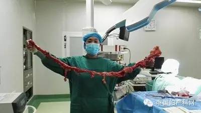 【妇产微视】腹腔镜下大子宫切除经验分享