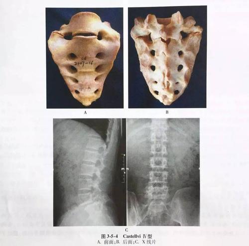 Ⅳ型:混合型,即一侧为横突与骶骨形成假关节,另一侧则形成骨性融合(图