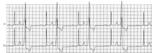 室性早搏二联律