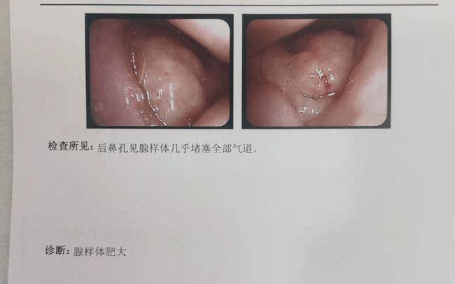 打呼噜就是腺样体肥大吗?有药可用吗?
