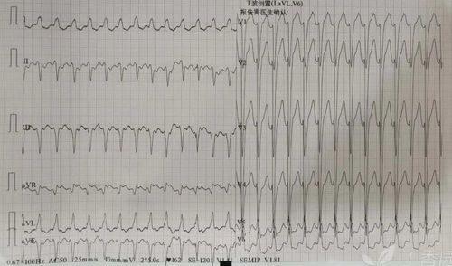 易误诊的房性心律失常|达摩心电图专栏