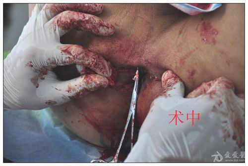 低位肛瘘术前术后照