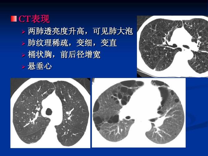 胸部疾病ct诊断 ct表现 两肺透亮度升高,可见肺大泡   肺纹理稀疏,变