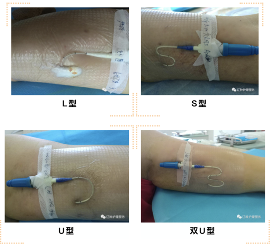 如何正确固定picc导管外露部分?