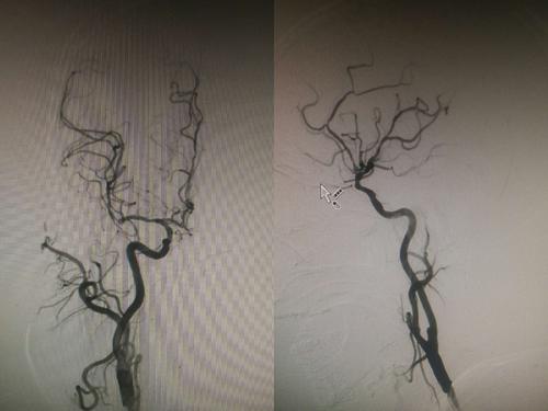 9月17日颈动脉狭窄支架植入一例