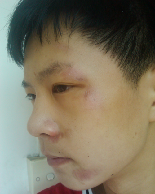 脸上有褐色的疤,是擦伤后脱咖形成的,请问如何除掉?有