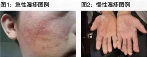 9种过敏性皮肤鉴别_症状