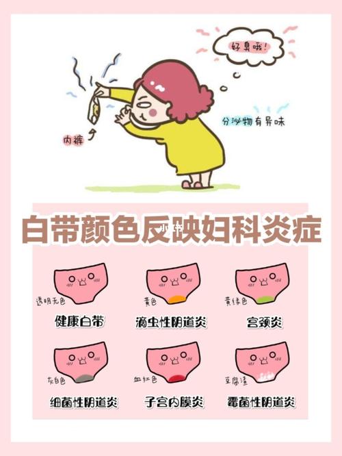 白带颜色辨妇科75是霉菌71是滴虫71一看便知_妇科_医疗健康
