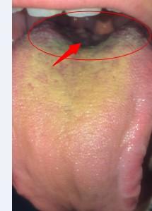 请问下这舌头上的里边长的这么多的象水泡