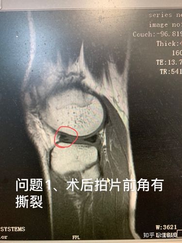 1,半月板术后核磁共振显示前角有撕裂,术前几乎没有损伤前角.