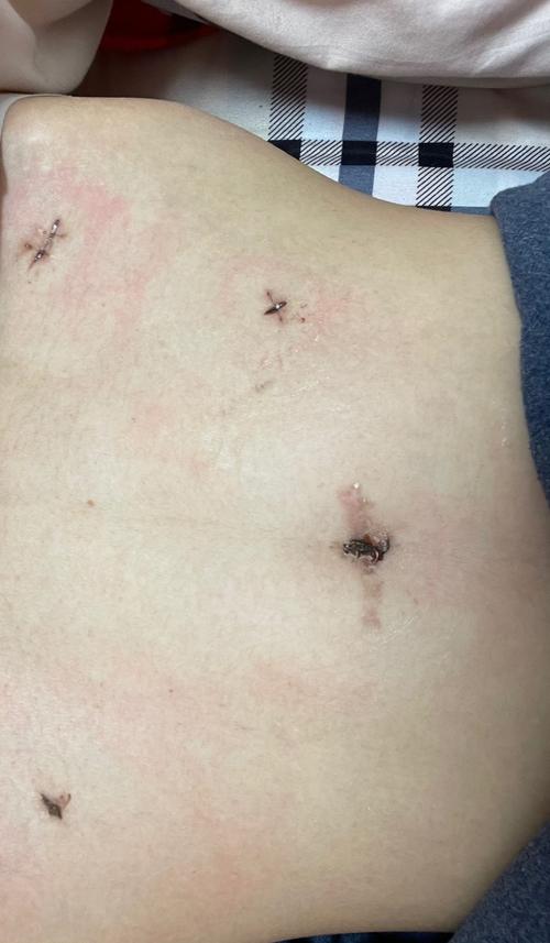 28岁宫外孕 我的腹腔镜手术历程