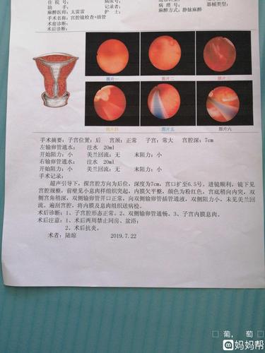 22做的宫腔镜,有懂的吗?我是不是有子宫内膜炎,帮我看看