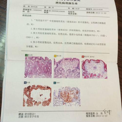 并要求在胃镜下要多取几块活检,以确定有无癌变,最后病理检查为"粘膜