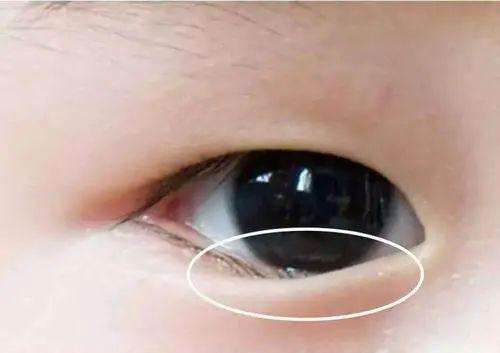 孩子眼睛红又肿眼屎黄又多可不是上火这么简单