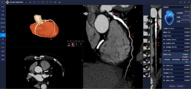 cmef|医准智能冠脉cta智能分析系统明察秋毫高效全面
