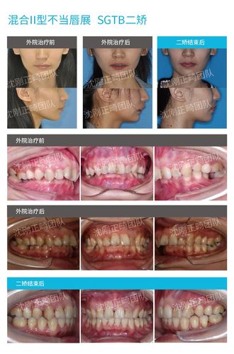 下图为沈刚正畸团队为某混i病例使用sgtb进行二矫时口内口外对比照