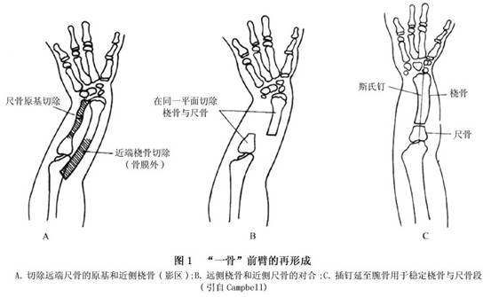 先天性尺骨缺如