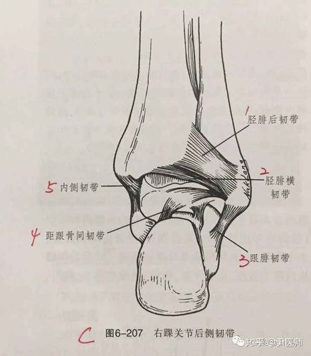 踝关节韧带损伤:1外侧副韧带损伤,2三角韧带损伤,3下胫腓联合韧带损伤