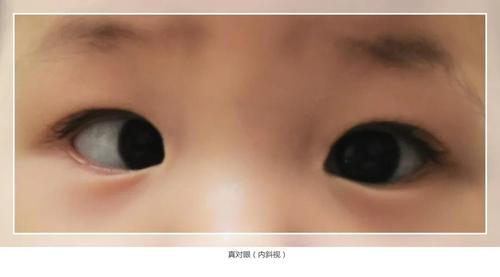 "斗鸡眼"还有真假? 如何区分