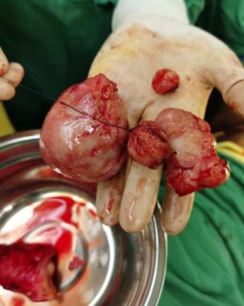 为什么腹腔镜子宫肌瘤剥除手术中尽量不使用粉碎器