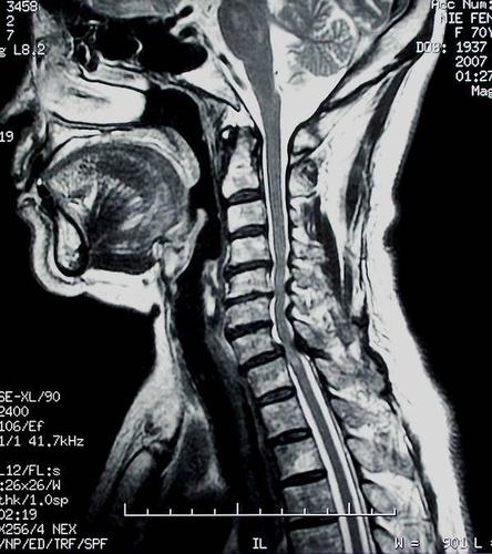 一失足何以成千古恨为何轻微外伤也可能对颈椎病患者造成严重后果