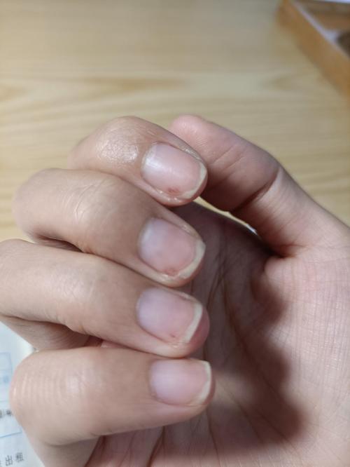 做完两次美甲之后,指甲受损严重,一朝回到解放前