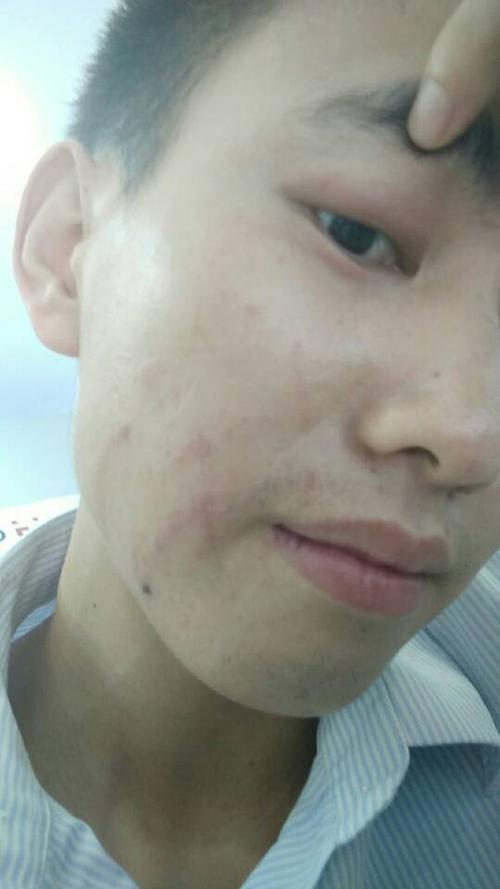 昨天出去旅游,回来就觉得眼皮处有点疼.求告知这是皮肤病还是过敏?