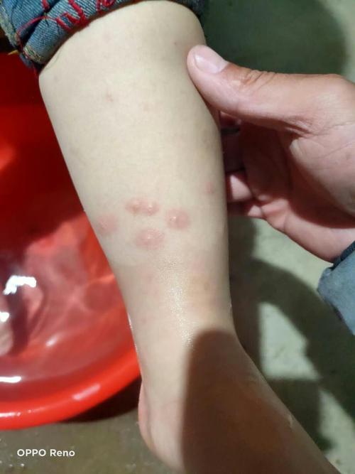 丘疹性荨麻疹反复发作久治不愈的原因分析