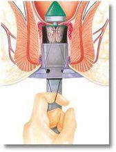 2,无痛:将脱出肛门的痔疮拉回原位,同时截断向痔疮提供血液的血管,不
