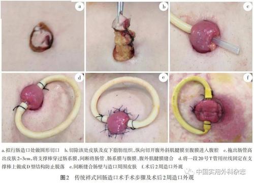 论著皮桥袢式回肠造口在腹腔镜低位直肠前切除术中应用价值研究本文配