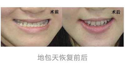 成都华美牙科地包天牙齿矫正手术