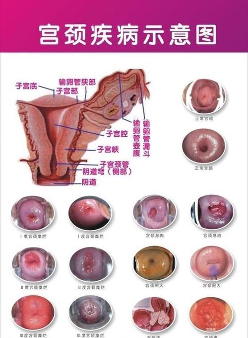宫颈糜烂图片