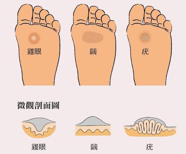 二是看数量,鸡眼通常只会长一两个,最多三个,如果脚上同时有三四处