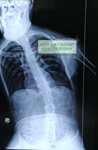 强直性脊柱炎髋关节强直怎么办?